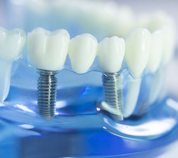 Middletown Township Dental Implants