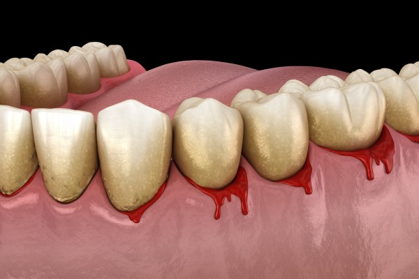 What Gum Disease Looks Like