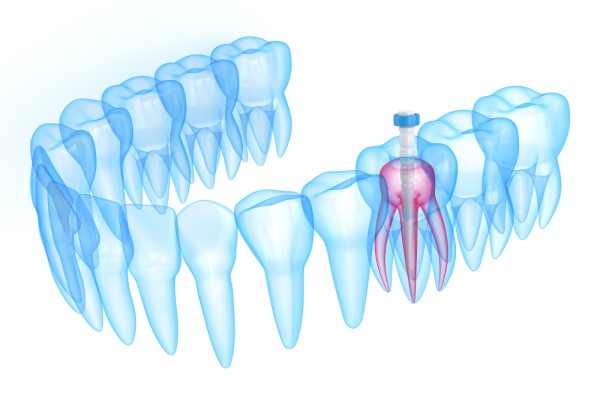 Why Do I Need A Crown After A Root Canal?